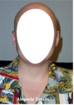 Alopecia Totalis involves hair loss over the entire scalp.