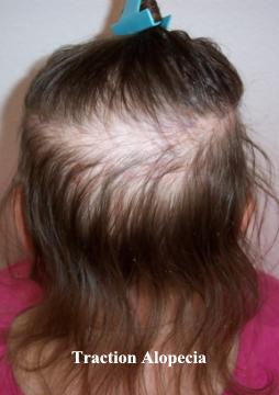 Ruxolitinib: The Pill That Could Cure Alopecia