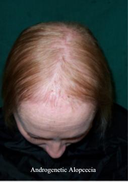 Treatment for Hair Loss in a Woman | eHow