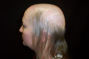 Female baldness